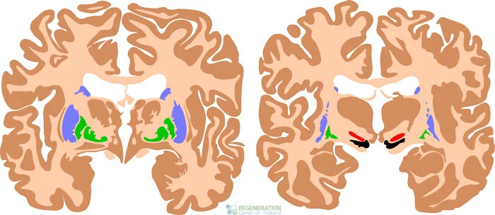 therapy-for-cerebral-palsy-cp-treatment