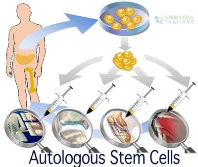 autologous-MSCs-bone-marrow-illiac-crest-extractions