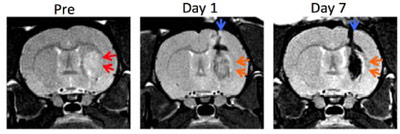 before-after-stem-cell therapy for stroke