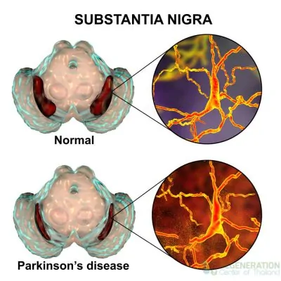 substantia-nigra-Stem Cell Treatment for Parkinson's