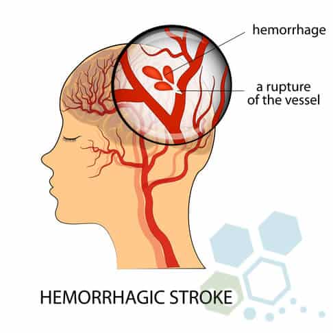 hemorrhagic-stroke-stem cell treatment-after