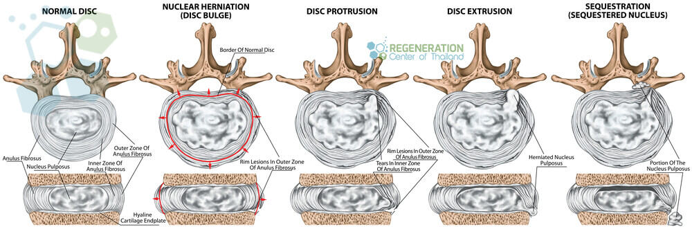 stem-cells-for back pain and herniated-discs