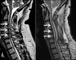 spinal-stenosis-stemcell-therapy