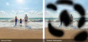 stemcells-Diabetic-Eye-Diseases