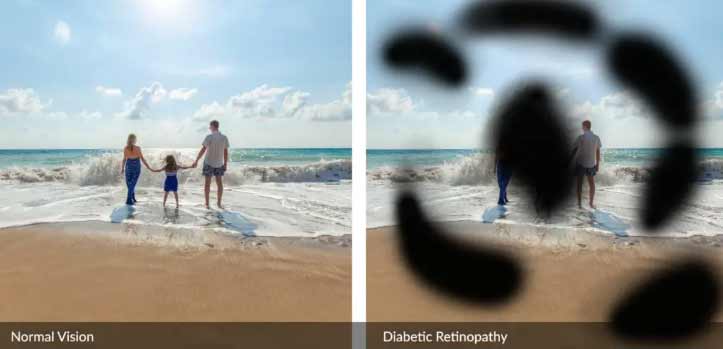 stemcells-Diabetic-Eye-Diseases