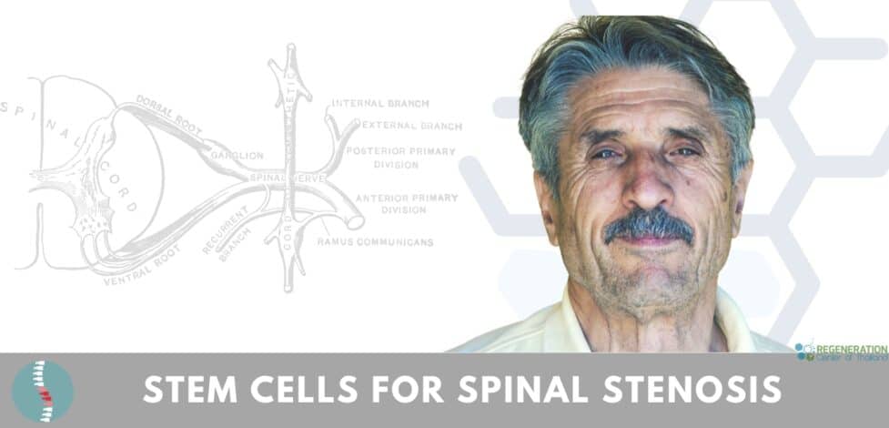 Stem Cell Therapy for Spinal Stenosis