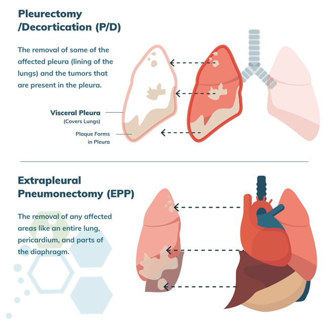 new-mesothelioma-treatment-center-regeneration-center
