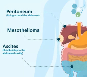 stem-cell-immunotherapy-treatment-for-mesothelioma-