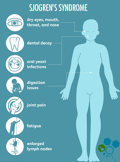 stem-cells-for-sjogren's-syndrome