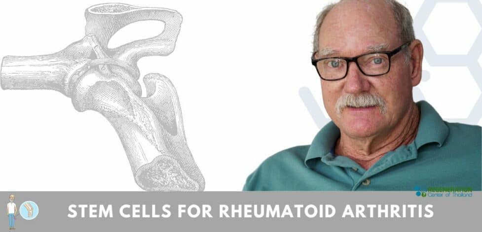 Stem Cell Treatment for Rheumatoid Arthritis Autoimune