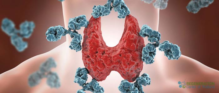stem-cell-treatment-chronic-lymphocytic-thyroiditis