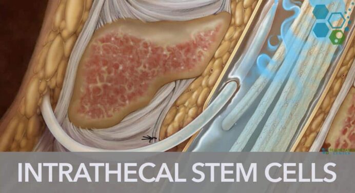 Intrathecal Delivery of Stem Cells in the Subarachnoid space