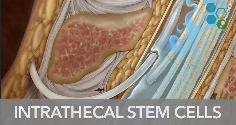 Intrathecal-administration-of-stem-cells
