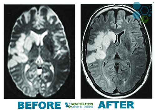 Treat-Aphasia-Stemcells