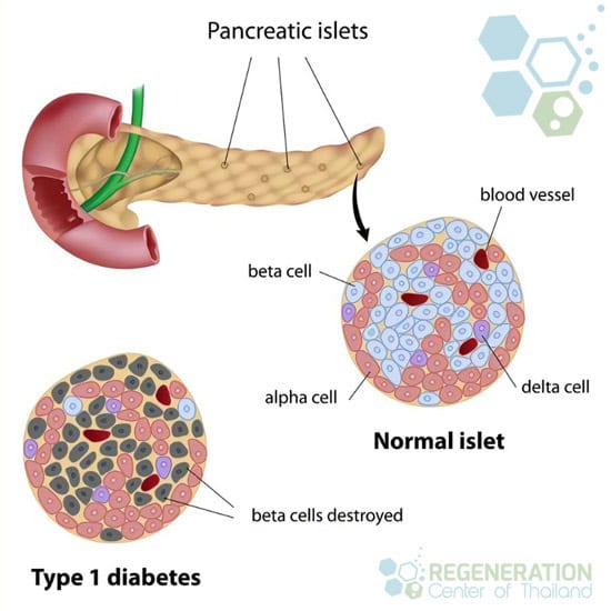 islet-cells-replacement-type1-diabetes-regen-center
