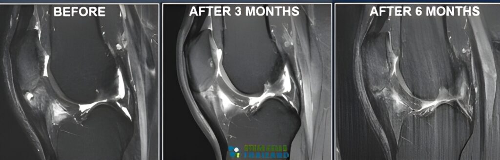 before-after-msc-platelet-rich-plasma-stemc-cell-therapy-thailand-MRI