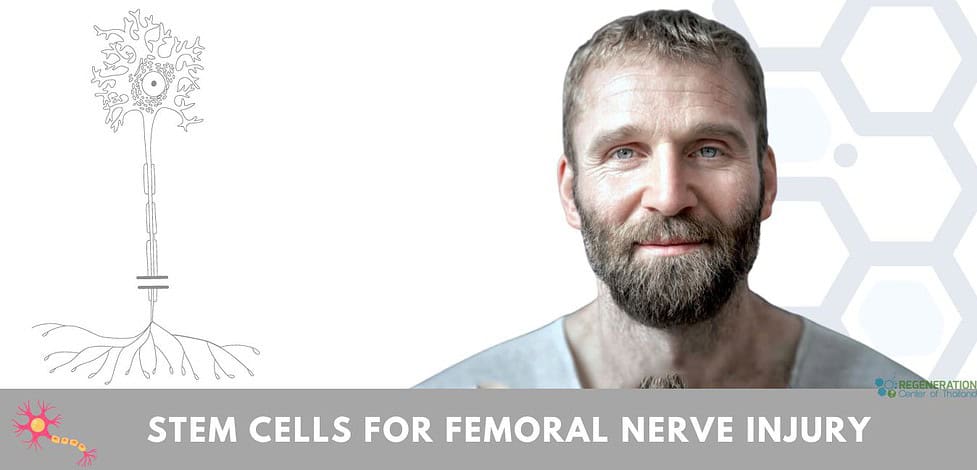 Stem cells treatment for Femoral Nerve Pain injury