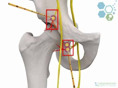 femoral-nerve-blocks-stem-cell-treatment