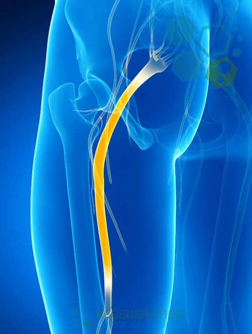 stemcell-therapy-Femoral-Nerve-Pain-