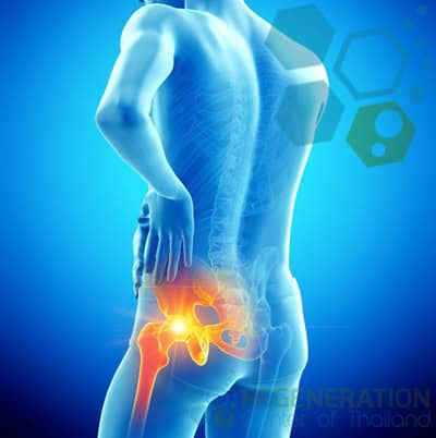 stemcell-treatment-Femoral-Nerve-injury